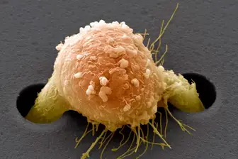 Uma célula de câncer de mama (colorida artificialmente) sobe por uma película de suporte em um experimento de laboratório. (Foto: Divulgação: Steve Gschmeissner/SPL)