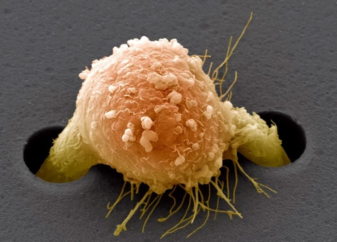 Uma célula de câncer de mama (colorida artificialmente) sobe por uma película de suporte em um experimento de laboratório.